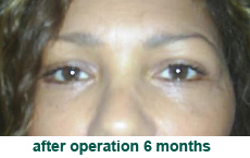 plastic-surgery-blepharoplasty